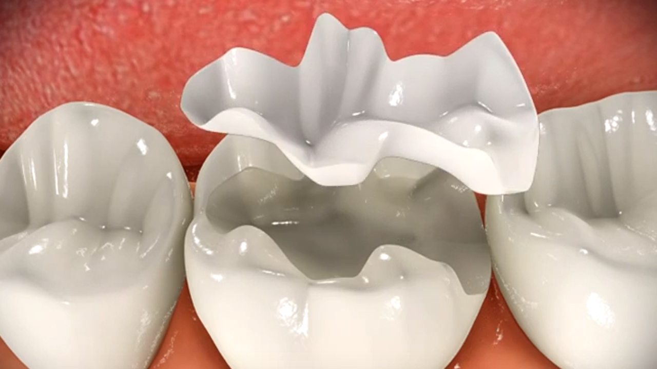 dental inlays and onlays