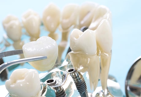 How to Fix Worn Down Teeth - Treatment and Repair - Vancouver