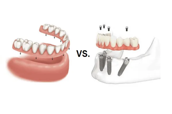 dental implant vs denture