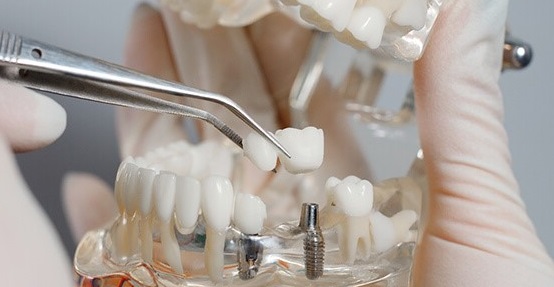 dental implants BC