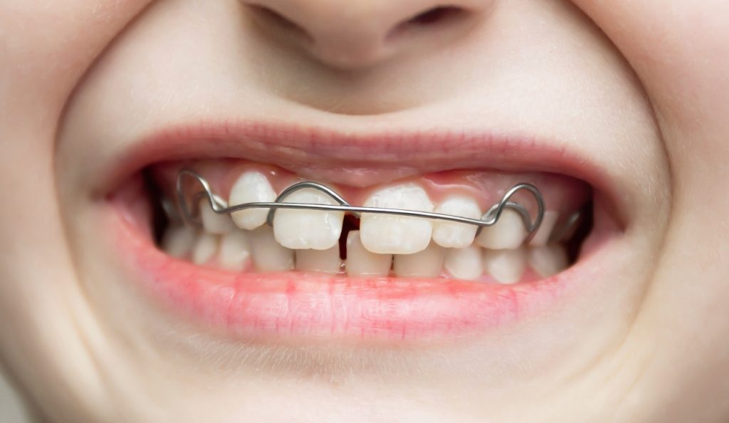 girl with removable orthodontic