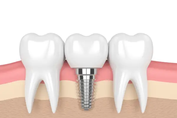 2 teeth and one implant tooth