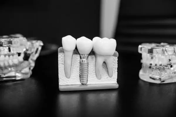 dental implant replica black and white