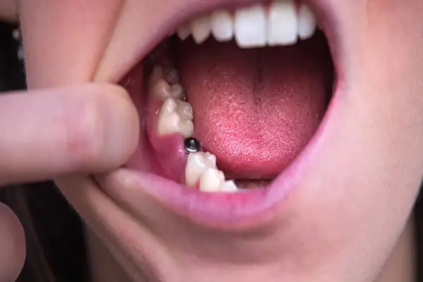 an implant tooth for a woman