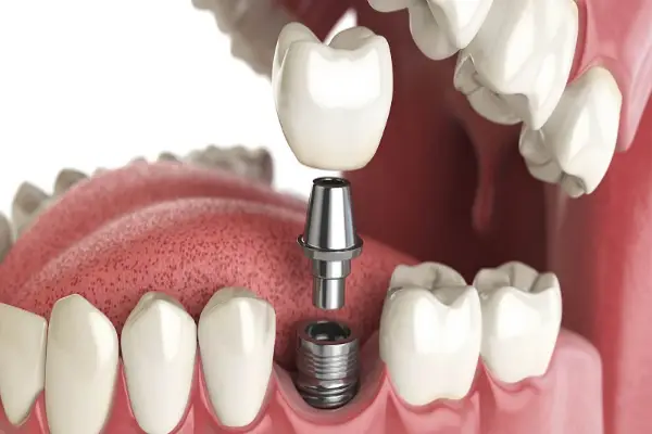 dental implant for missing teeth