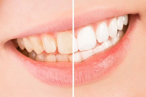 Painless Teeth Whitening Affordable