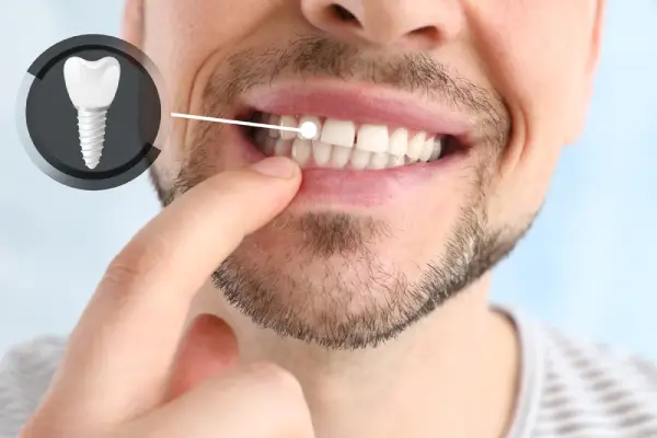 Showing a man's front teeth