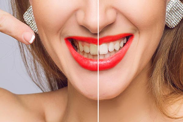 painless teeth whitening