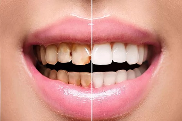 before and after whitening