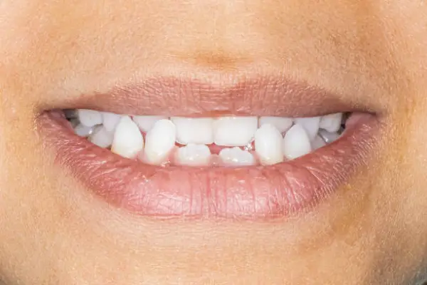 malocclusion