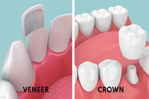 veneers vs crowns