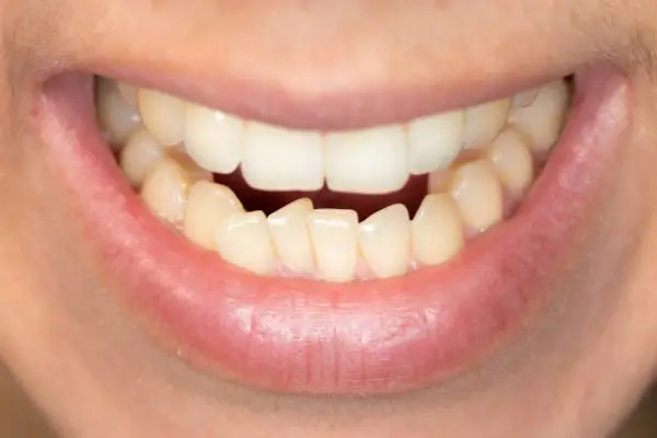 A person's disorganized teeth