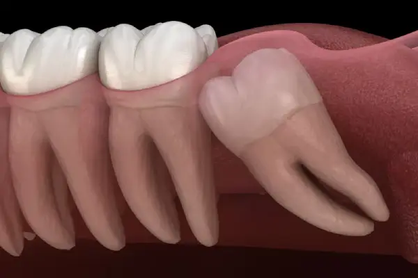 two teeth and one wisdom tooth