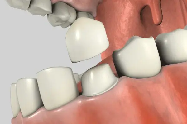 type of crowns