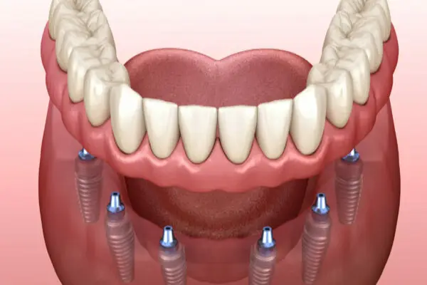 implant denture