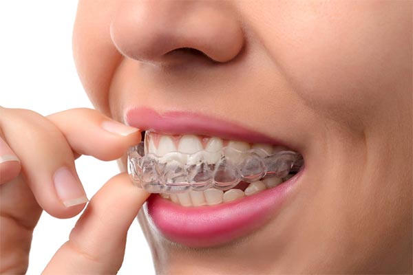 girl with Aligners