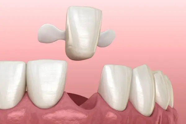 a kind of dental bridges