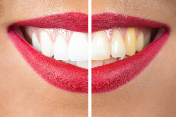 yellow teeth treatment example