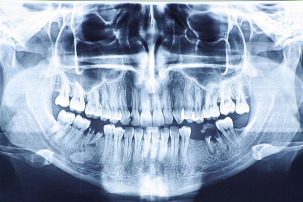 dental x-ray image