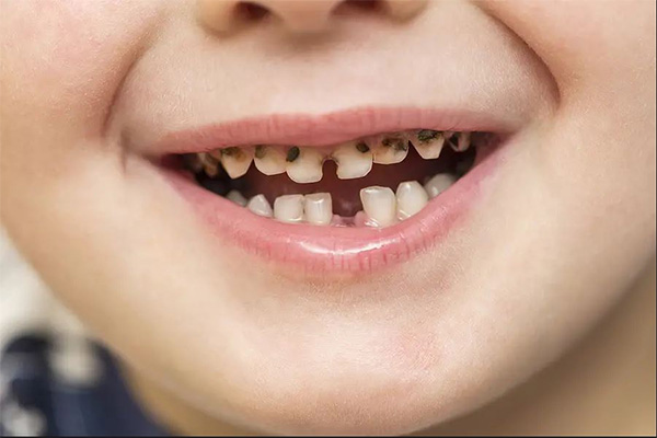 boy with Cavities teeth