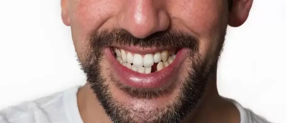 a man with one missing teeth