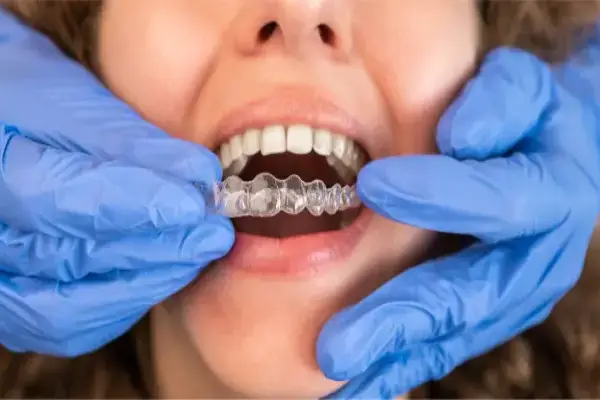 clear braces for a woman