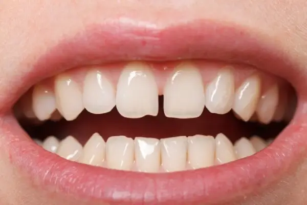 showing diastema