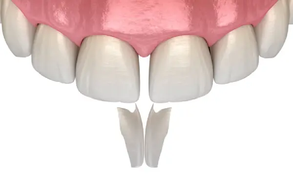 diastema on a replica