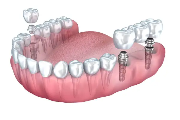 showing implant and bridge of replica