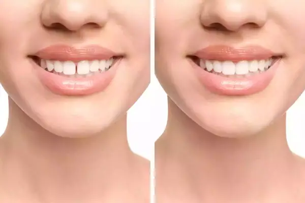 A woman's face with and without diastema