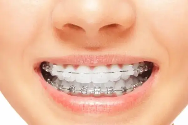 woman with alternatives to braces