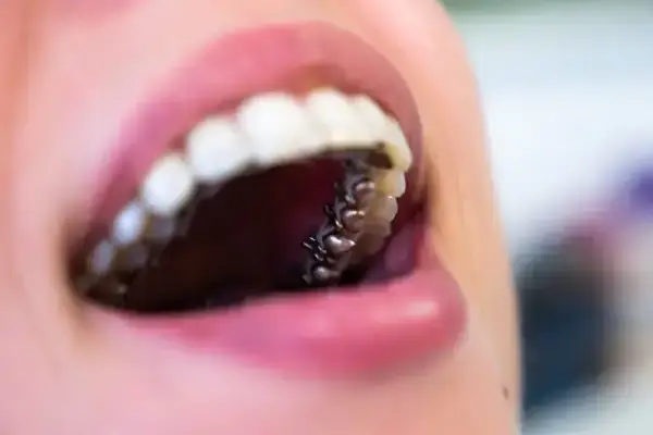 a mouth of a woman with lingual braces