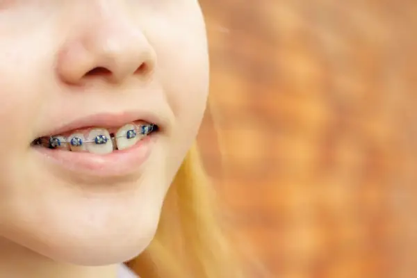 Orthodontic teeth of a girl