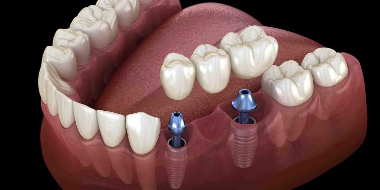 What is the Process for Getting Dental Implants