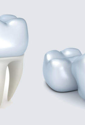 Dental Crowns in Vancouver