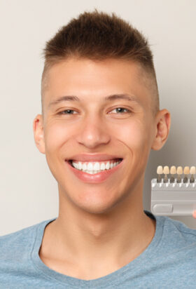 Dental Veneers in Vancouver