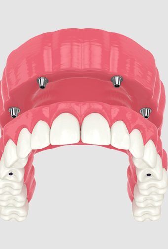 What Are the Trusted Options for Multiple Tooth Replacement in Vancouver?