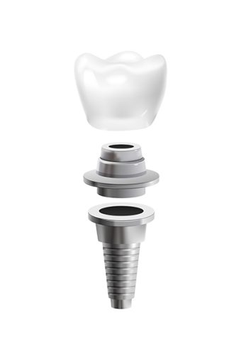 What Is the Process of Dental Implant Repair in Vancouver?