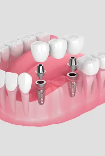 What Vancouver Dentists Recommend for Daily Dental Implant Crown Care