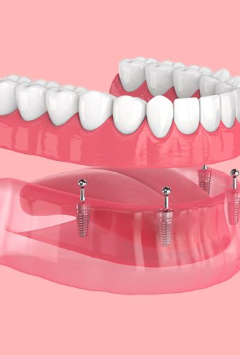 All-on-4 Implants for Seniors: What You Need to Know