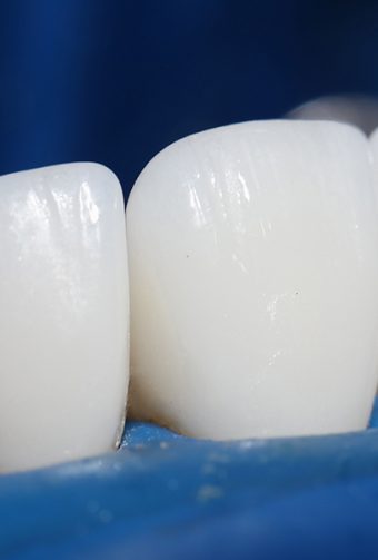 Why a Dental Bridge Is the Easiest Way to Eat and Speak Comfortably Again